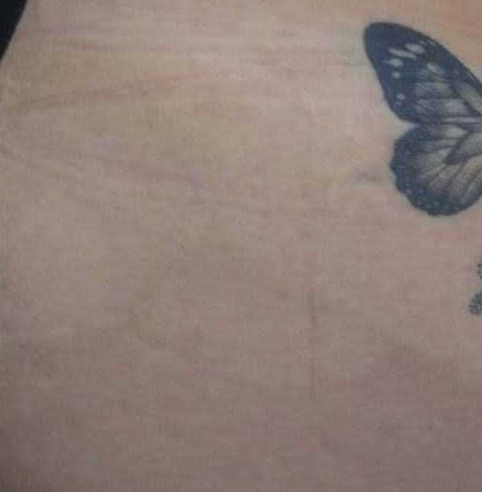 Depois do tratamento de estrias — quadril